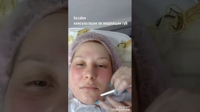 Консультация по коррекции губ|Москва