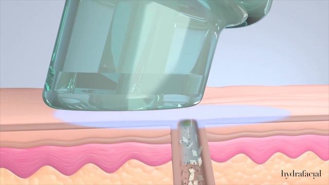 HydraFacial в клинике молодости Helen Baden | Уход и лечение вашей кожи смотреть онлайн