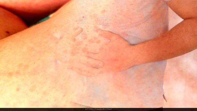 Что такое менингит? смотреть онлайн