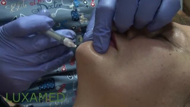 Контурная пластика подбородка филлером Facetem смотреть онлайн