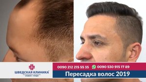 Пересадка волос 2019