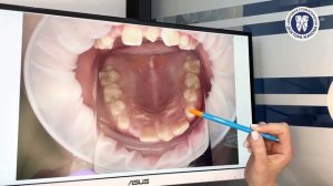 Зачем лечить молочные зубы?