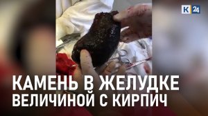 Мужчине удалили из желудка 25-сантиметровый камень. Он образовался из съеденной хурмы