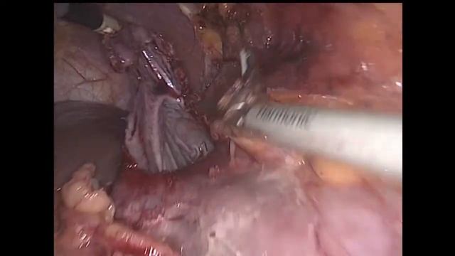 Laparoscopic Left Kidney cyst deroofing / Лапароскопическое иссечение кисты левой почки смотреть онлайн