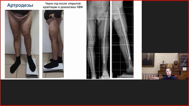 Использование внешней фиксации при патологии крупных суставов (разбор клинических случаев).mp4