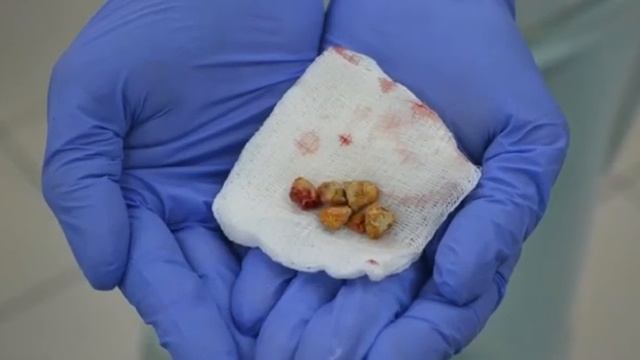КАМНИ В ПОЧКАХ - Причины, профилактика и лечение / Мочекаменная болезнь