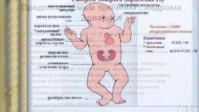 Синдром Эдвардса. Синдром трисомии 18. Причины, диагностика, лечение