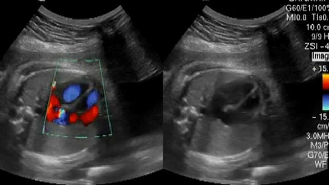 Допплер сердца плода 20 недель