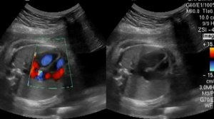 Допплер сердца плода 20 недель