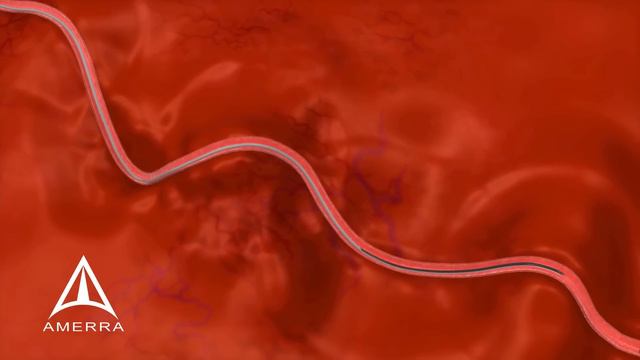 Uterine Fibroid Embolization (UFE) - surgery animation