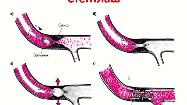 Ўткир коронар синдром билан оғриган беморлар смотреть онлайн