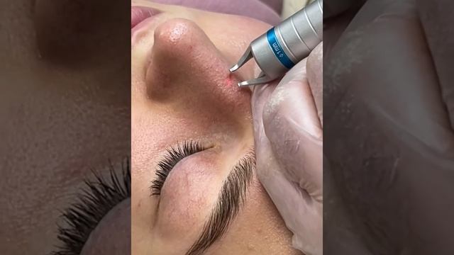 Удаление сосудов диодным лазером 980 nm #notattooukraine #удалениесосудов #удалениесосудистойсетки смотреть онлайн