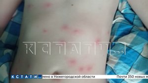 Черви-церкарии с приходом жары нападают на людей в водоемах. У детей сотни укусов.