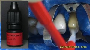 Фіксація вініра / Variolink N