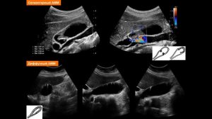 Ультразвуковая диагностика. Доктор Иогансен. Выпуск 39. Гиперпластические холецистопатии. Часть 2.