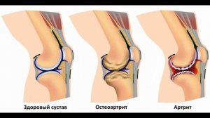 ХВАТИТ ЭТО ХРУСТЕТЬ!!! Почему хрустят колени? Топ причин