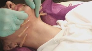 НИТИ в субментальной области(фрагмент).