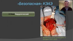 Каротидная эндартерэктомия: безопасное вмешательство с позиции ангиохирурга