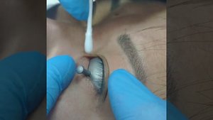 Лазерное удаление папиллом на веке. С использованием защиты глаз от лазера СО2