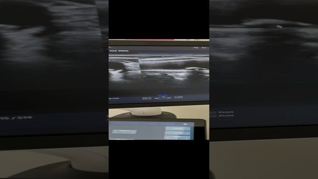 Исследование сонных артерий на предмет риска инсульта. Часть 2. Сосудистый хирург. Флеболог Москва
