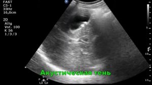 079 - УЗИ - Камень в желчном пузыре