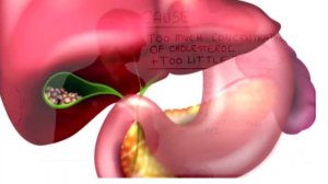 Стоить ли удалять желчный пузырь при камне