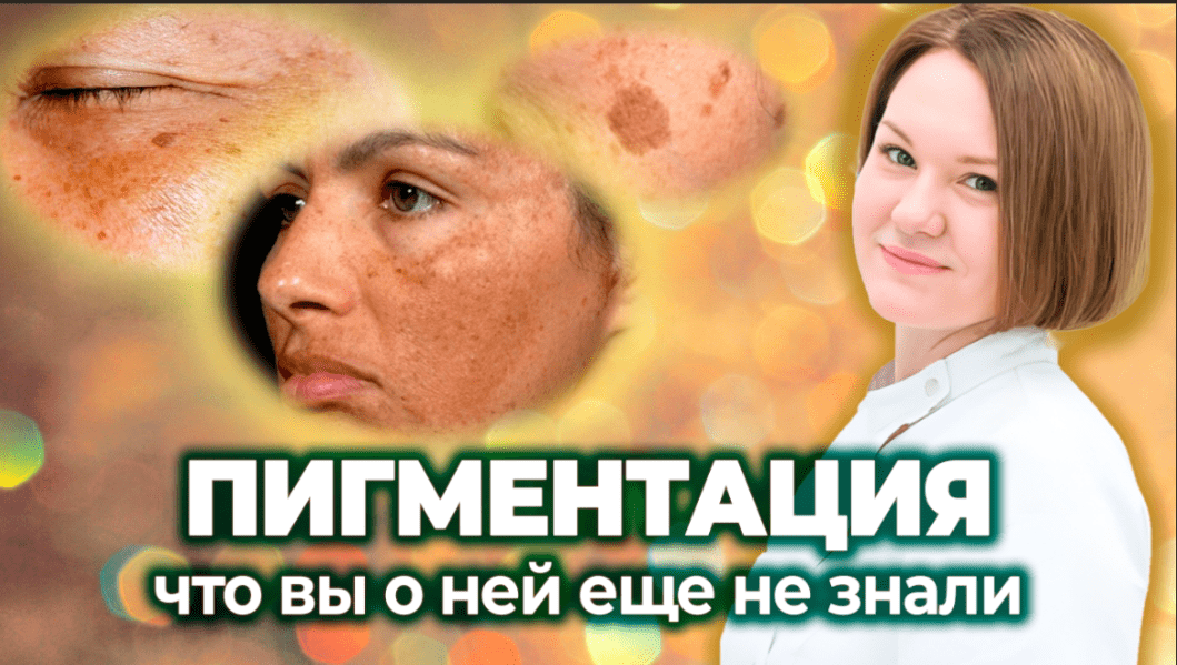 Пигментные пятна