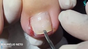 UNHA ENCRAVADA MUITO  PROFUNDA #podologomaurelio #ingrowntoenail