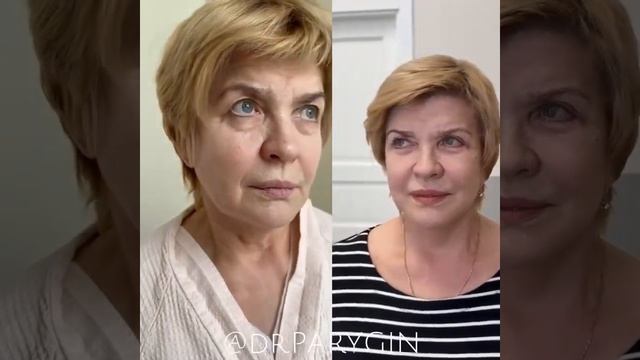 ПРЕОБРАЖЕНИЕ ПОСЛЕ ПЛАСТИКИ ДО И ПОСЛЕ смотреть онлайн