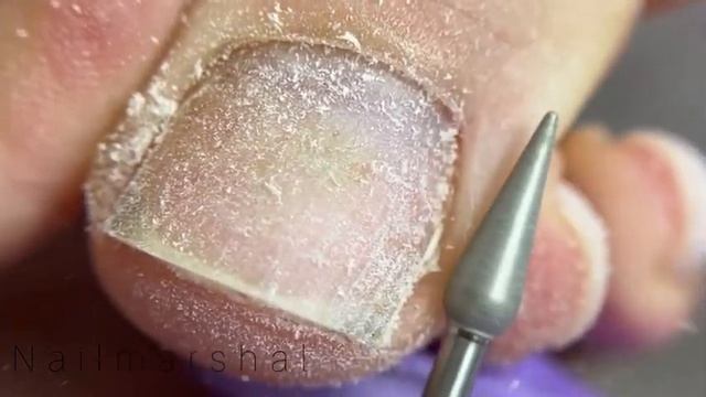 Обработка пальчика с пенкой от @pink_royss_cosmetics #педикюр #педикюрмосква #аппаратныйпедикюр #