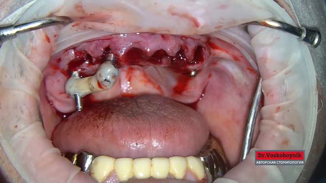 #2 Тотальна импланация верхняя челюсть, навигация удаление зубов, 4 импланта, мульты, балка лазерно смотреть онлайн
