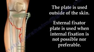 External Fixation With Locking Plate - Everything You Need To Know - Dr. Nabil Ebraheim