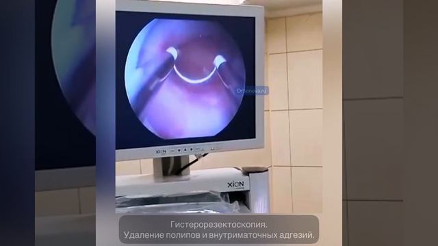 Гистерорезектоскопия. Удаление полипов и внутриматочных адгезий.
