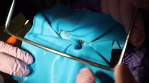 Наталья Адаева - Восстановление молочных зубов металлическими коронками.