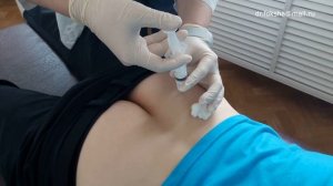 Лекарственная блокада грушевидной мышцы техника Piriformis Block Injections