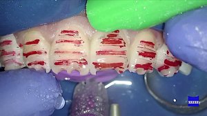 Препарирование длинное Ч