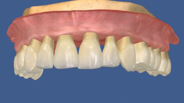 Периодонтия Генерализованный пародонтит в ч смотреть онлайн