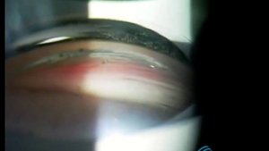 Гониоскопия с четырехзеркальной линзой