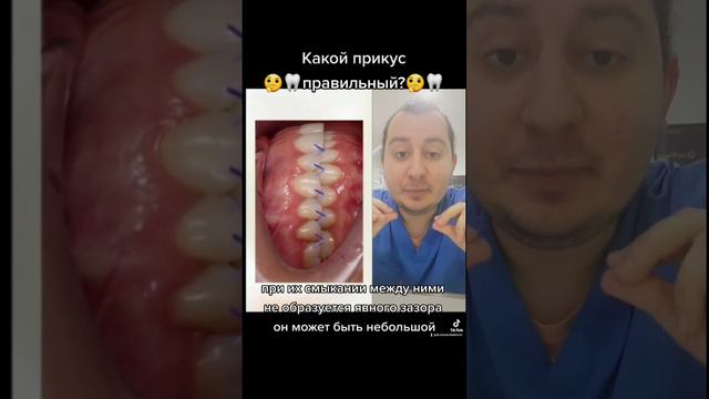 Какой прикус правильный?#дантист #зубнойврач #стоматолог #стоматология #прикус #ортодонт #ортодонти
