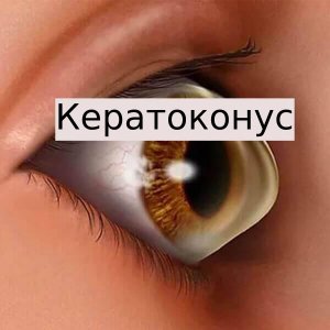 Лечение кератоконуса в Москве.