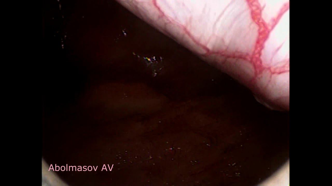 laparoscopic retrovesical colpopectinopexy vaginal vault prolapse full time 1,5x смотреть онлайн