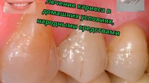 Лечение кариеса в домашних условиях, народными средствами