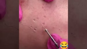 Самое залипательное видео давить прыщи Черные точки