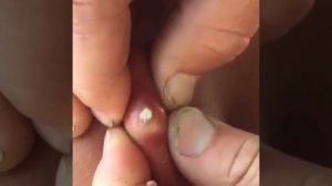 Major Satisfying Pimple Popping | 2019 | Part 2.