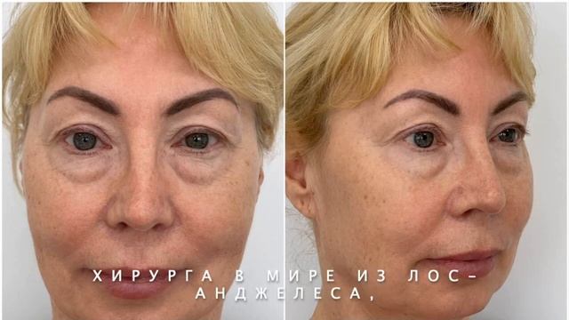 Верхняя и нижняя блефаропластика до и после. Пластический хирург Архангельск, Тула. Виктор Козлов