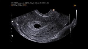 Анэмбриония на УЗИ(13-9-17)