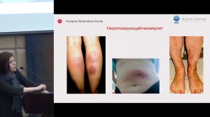 Карчевская Н.А., Дефицит альфа-1-антитрипсина.