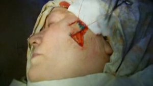 Пластика ромбовидного дефекта ротационным лоскутом