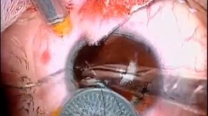 Имплантация искусственной иридохрусталиковой диафрагмы_Artificial iris-lens diaphragm implantation