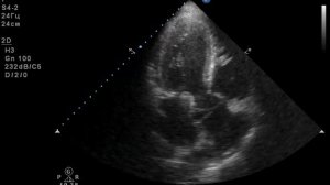 Эхо-КС. диссекция корня и восходящего отдела аорты